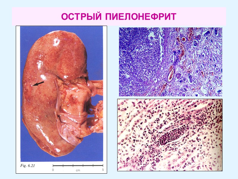 ОСТРЫЙ ПИЕЛОНЕФРИТ